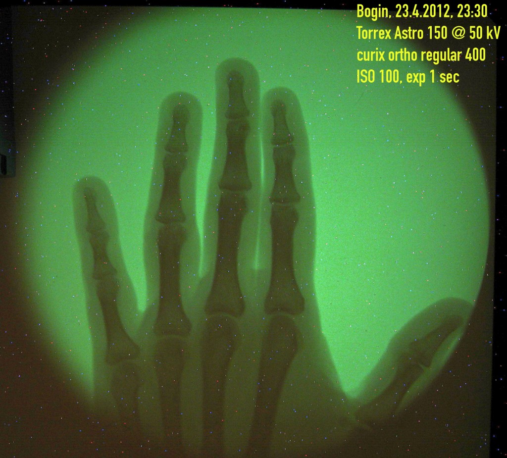 X-ray of a hand, 1